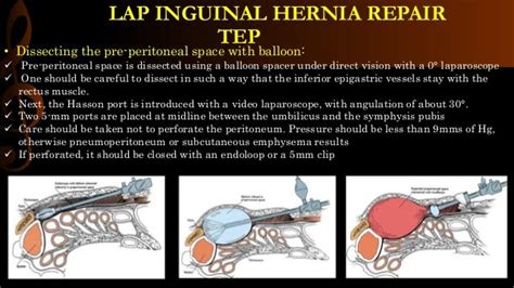 Lap Repair Of Inguinal Hernia