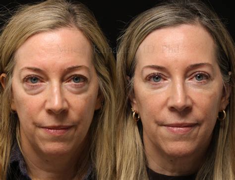 Laser Blepharoplasty Eyelid Surgery