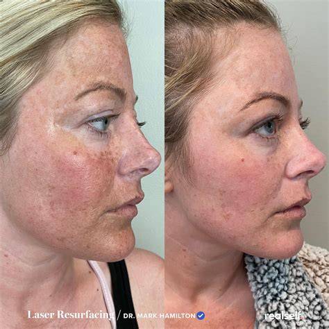 Laser For Hyperpigmentation