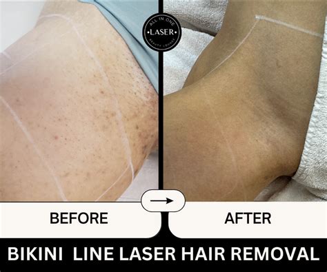 Laser Hair Removal Bikini