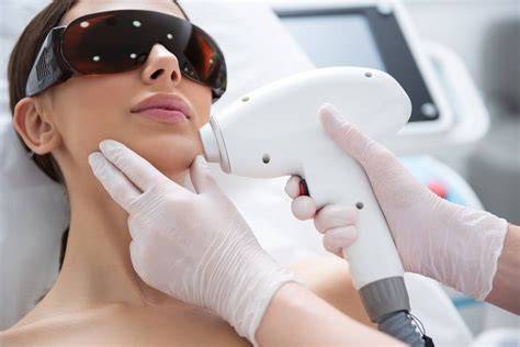 Laser Hair Removal Chin