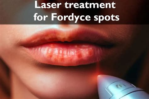 Laser Therapy For Fordyce Spots