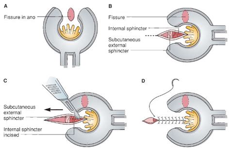 Lateral Internal Sphincterotomy