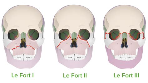 Le Fort 3 Fracture