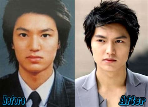 Lee Min Ho Face Surgery