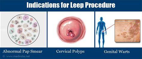 Leep Procedure For Hpv Virus