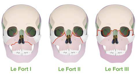Lefort 3 Fracture