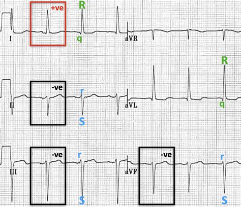 Left Anterior Fascicular Block Ecg
