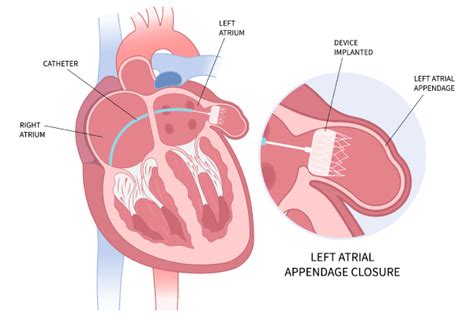 Left Atrial Appendage Closure