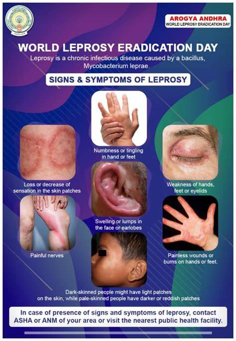 Leprosy Does It Still Exist