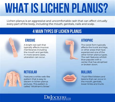 Lichen Planus Vaginal