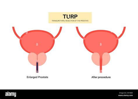 Life Expectancy After Turp Surgery