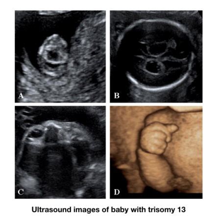 Life Expectancy For Patau Syndrome