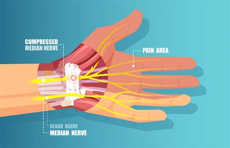 Ligament Tear Of Wrist