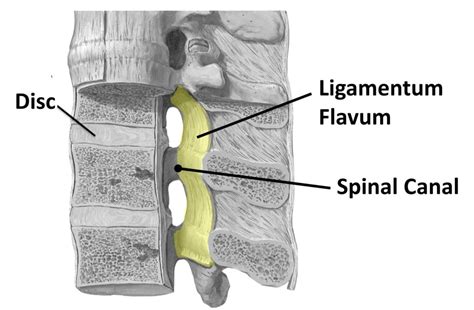 Ligamentum Flavum Hypertrophy