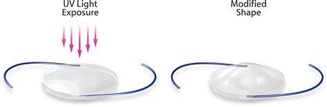 Light Adjustable Lens Cataract Surgery