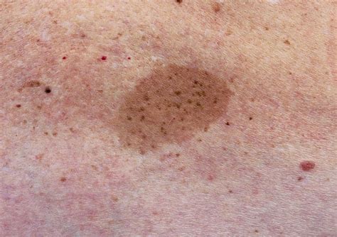 Light Brown Spots On Skin