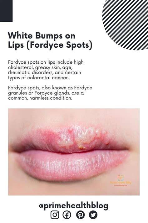 Lip Bumps White