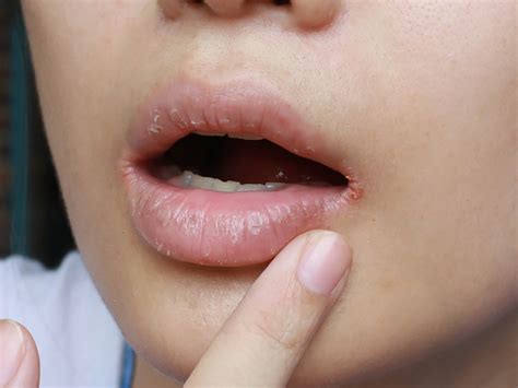 Lip Edge Crack