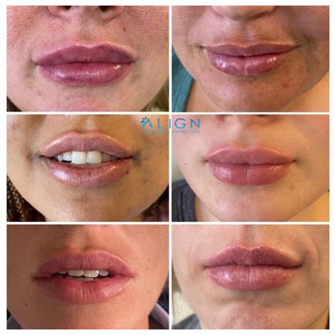 Lip Injection After Care