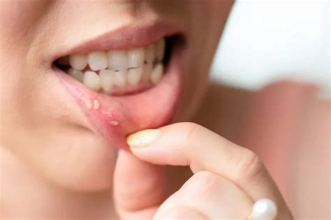 Lip Pimple Inside