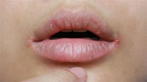 Lips Sides Cracking