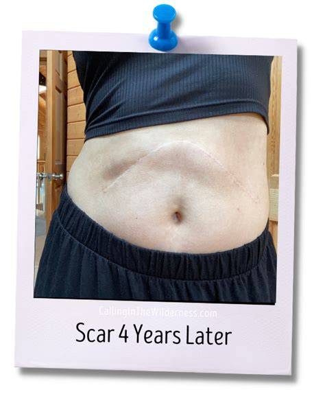Liver Transplant Scar