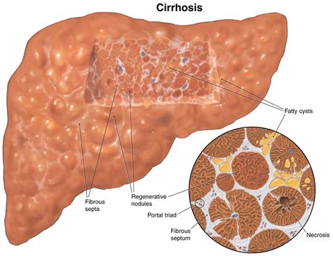 Liver With Cirrhosis