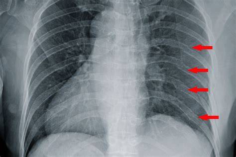 Longterm Effects Of Broken Ribs