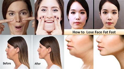 Lose Face Fat Surgery