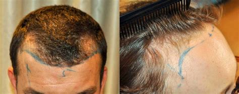 Losing Hair At Front