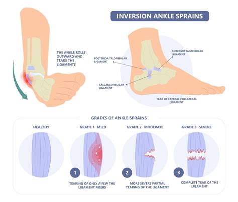 Low Ankle Sprain