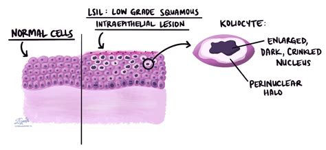 Low Grade Squamous Intraepithelial Lesion