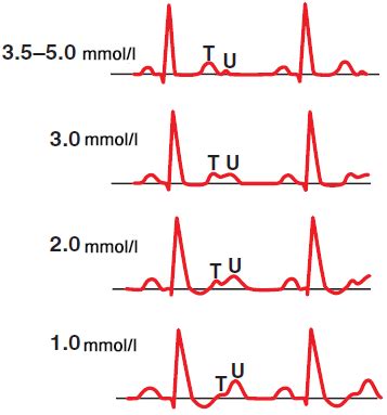 Low Potassium And Ecg