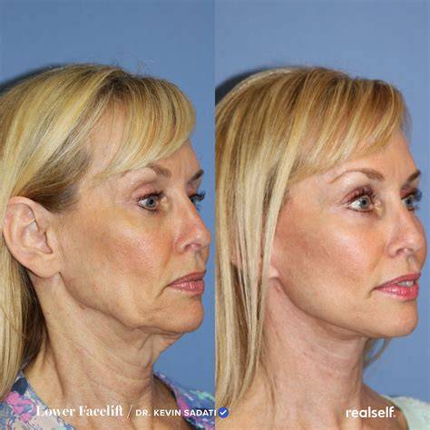 Lower Face Lift