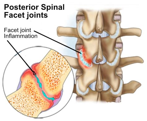 Lumbar Facet Arthropathy