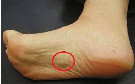 Lump Bottom Foot