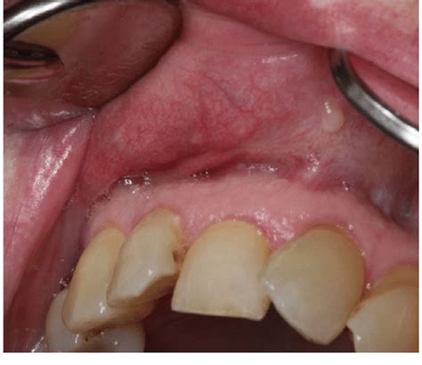 Lump In Upper Mouth