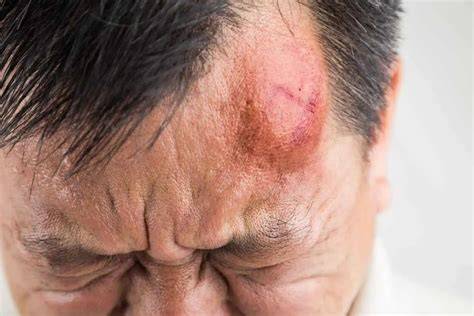 Lump On A Head