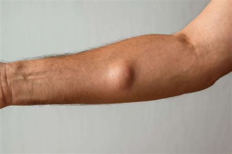Lump On Arm