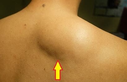 Lump On Back