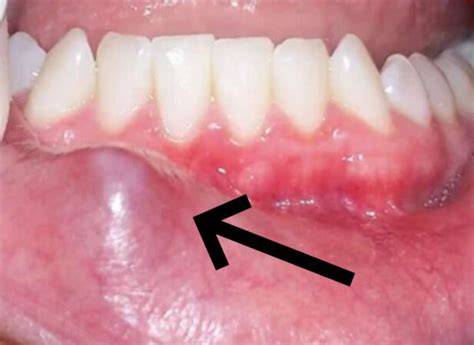 Lump On Lower Lip Inside