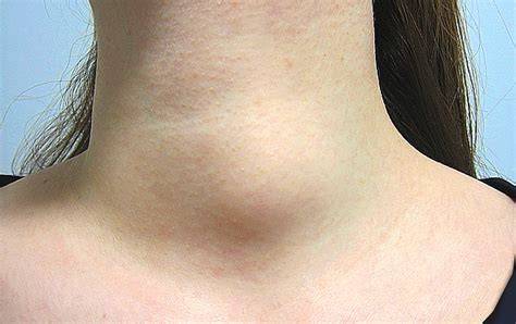 Lump On Thyroid Treatment