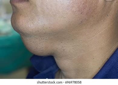 Lump Under Chin Near Throat