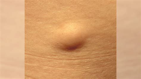 Lump Under Skin