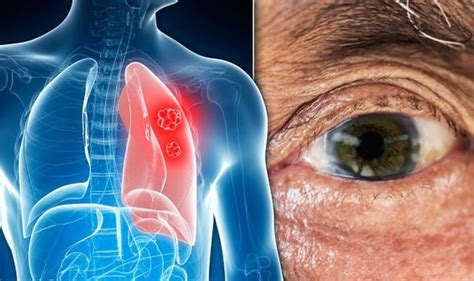 Lung Cancer Eyes
