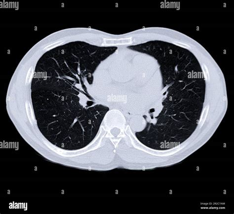 Lung Ct Scan
