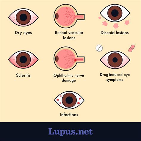 Lupus Does It Affect Eyes