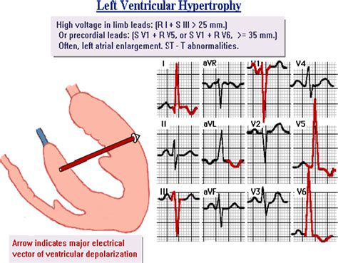 Lvh On Ecg