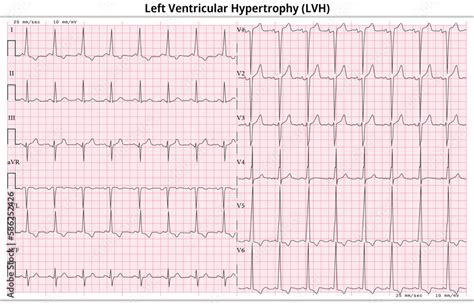 Lvh On Ekg